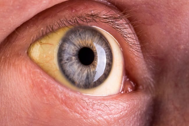 sindrom Dubin Johnson - alodokter