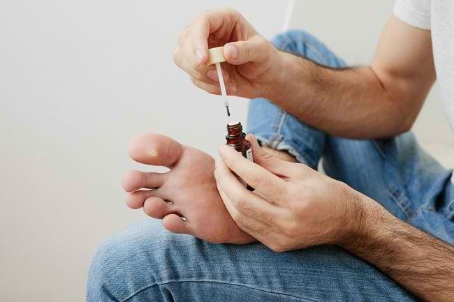 4 Cara Mengatasi Mata Ikan di Telapak Kaki - Alodokter