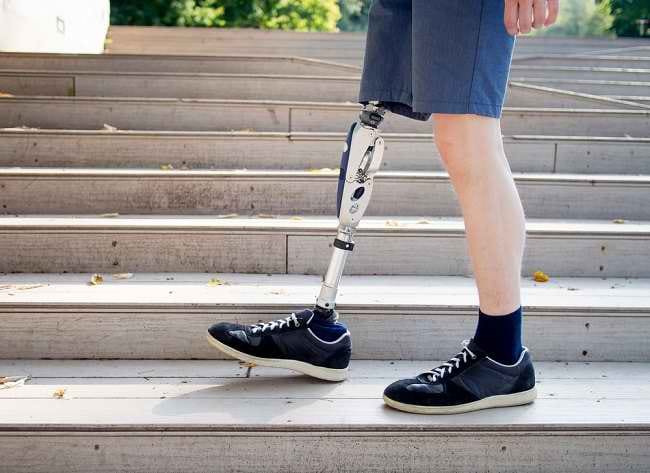 Kenali Penyebab dan Cara Mengatasi Phantom Limb Syndrome - Alodokter