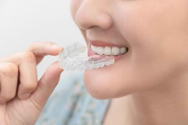 Kenali Jenis Retainer Gigi dan Cara Membersihkannya - Alodokter