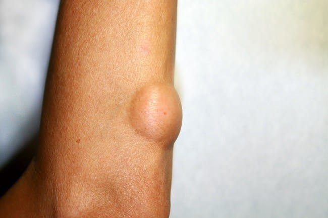 Liposarcoma - Alodokter