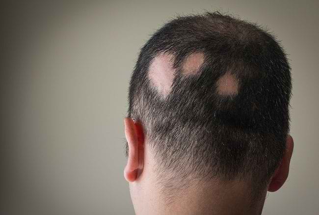 Kenali Penyebab Alopecia Areata dan Faktor Risikonya - Alodokter