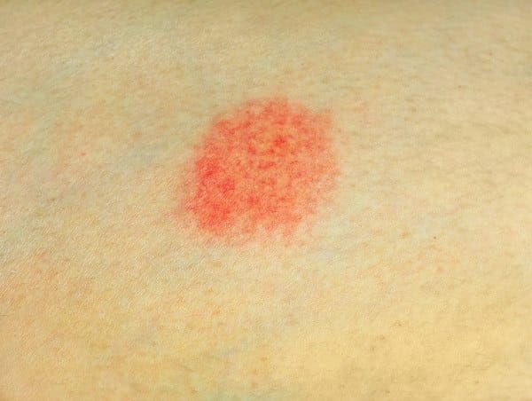 Dermatitis numularis - alodokter