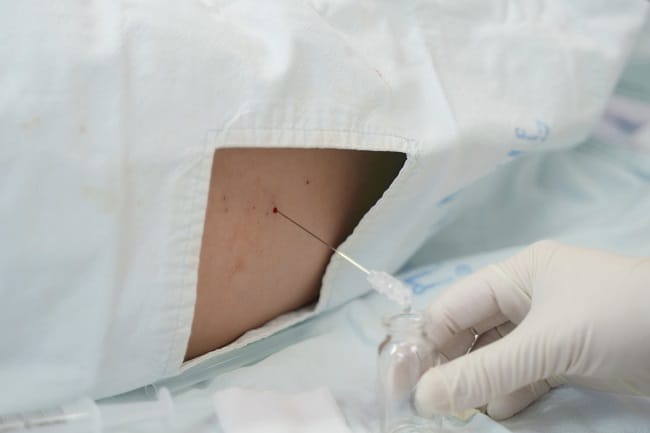 Informasi Seputar Lumbal Pungsi yang Harus Diketahui - Alodokter