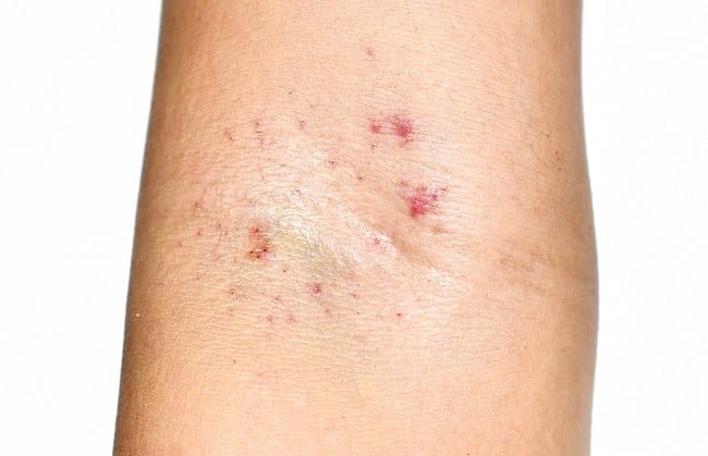 Thrombotic Thrombocytopenic Purpura - Alodokter