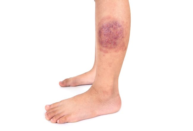 Tinea Corporis - Alodokter