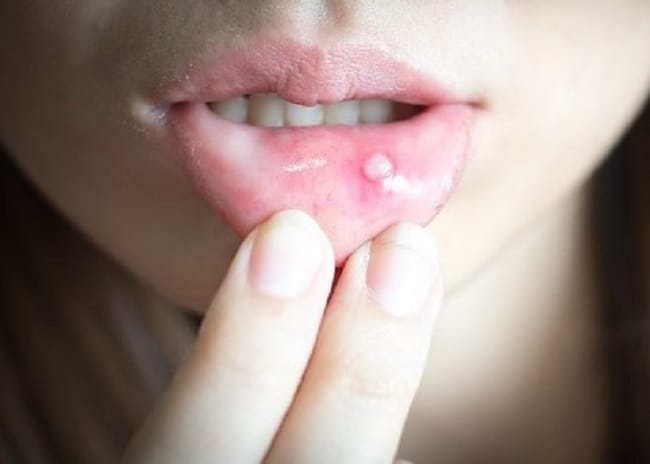 Sariawan - Alodokter 