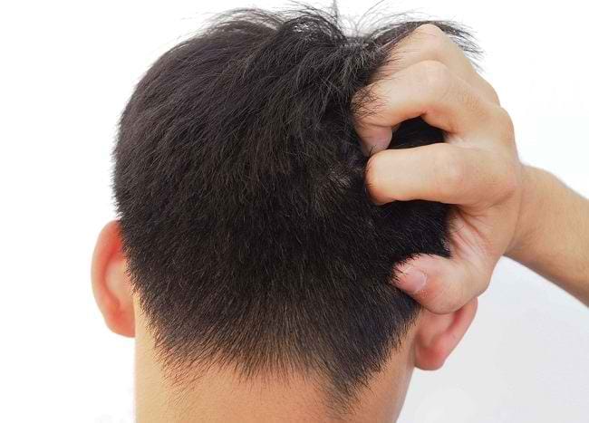 Ketahui Penyebab Kutu Rambut dan Cara Penularannya - Alodokter