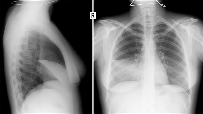 Pleuritis - Alodokter