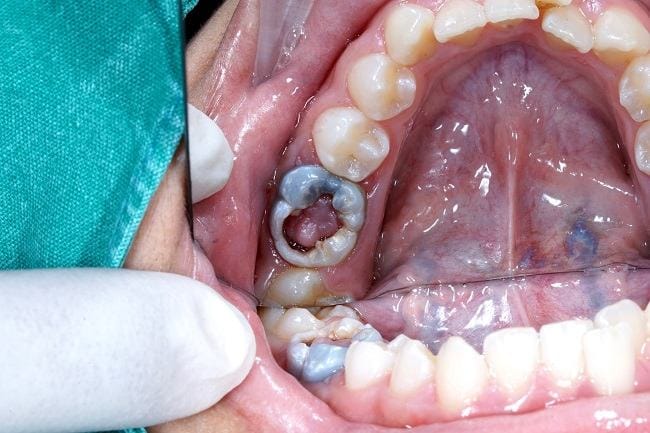 Polip Pulpa - Alodokter