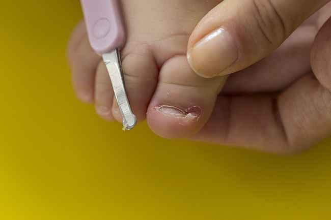 Kuku Cantengan pada Bayi, Ini Cara Mengatasinya - Alodokter
