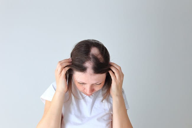 Alopecia Areata - Alodokter