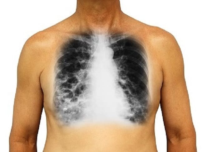 Bronkiektasis - Alodokter