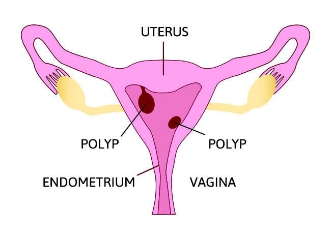 Polip Rahim - Alodokter