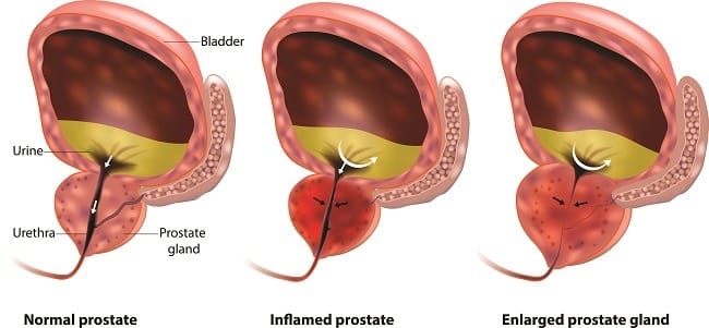 Prostatitis - Alodokter