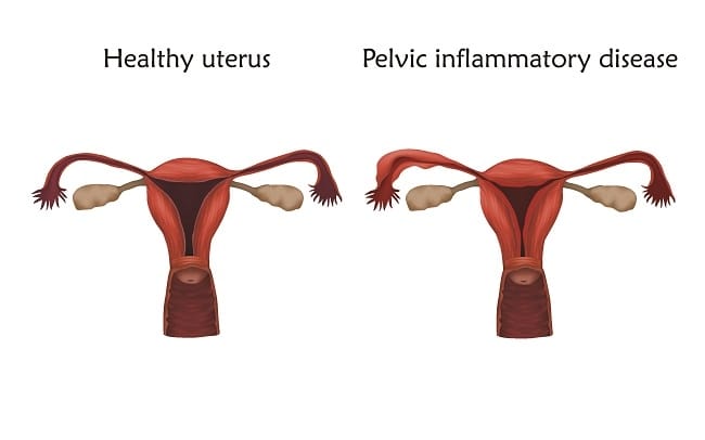 Radang Panggul - Alodokter