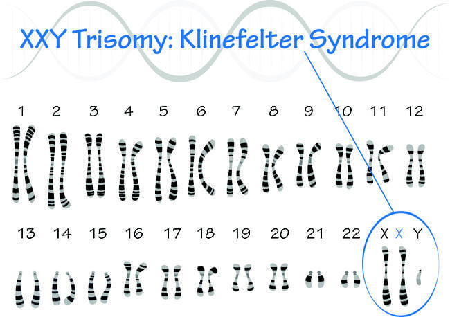 Sindrom Klinefelter - Alodokter