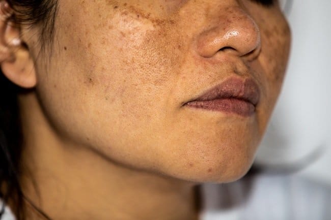 Hiperpigmentasi - Alodokter