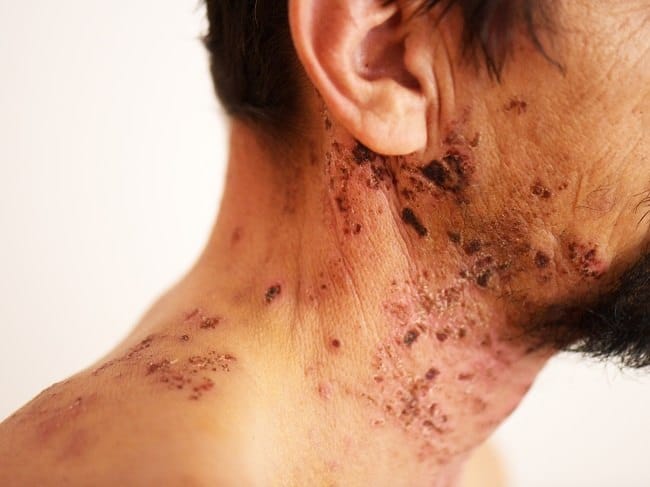 Ramsay-Hunt Syndrome - Alodokter