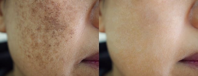 Melasma - Alodokter