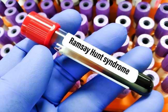 Waspadai Gejala Ramsay Hunt Syndrome pada Anak - Alodokter