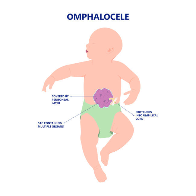 Omphalocele - Alodokter
