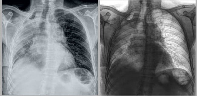 Atelektasis - Alodokter