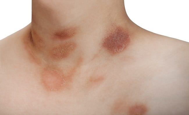 Pityriasis Rosea - Alodokter