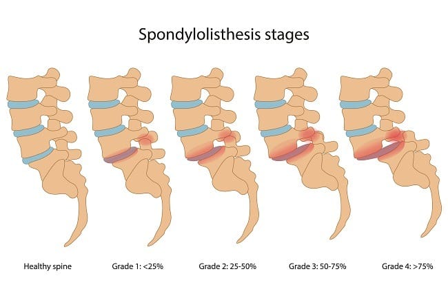 Spondylolisthesis - Alodokter