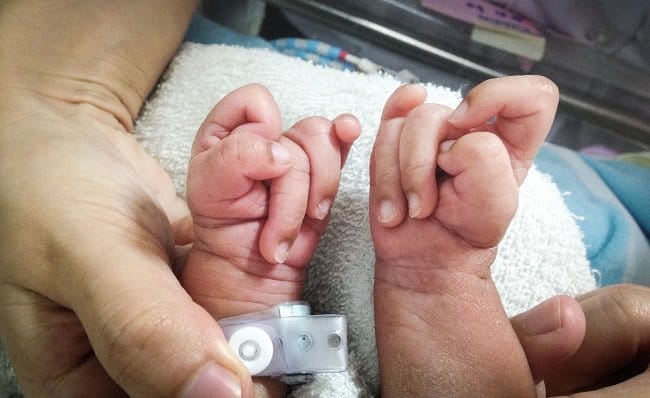 Sindrom Edward - Alodokter