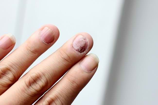 5 Gejala Psoriasis Kuku dan Langkah Pengobatannya - Alodokter