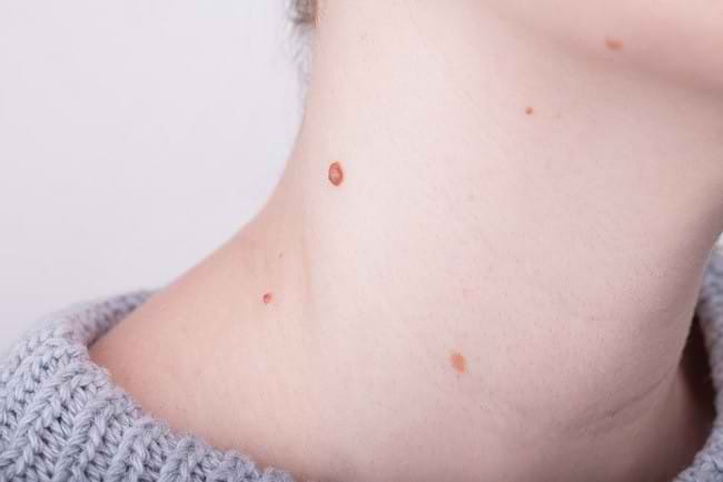 Kutil di Leher Dapat Menular, Cari Tahu Cara Mengatasinya - Alodokter