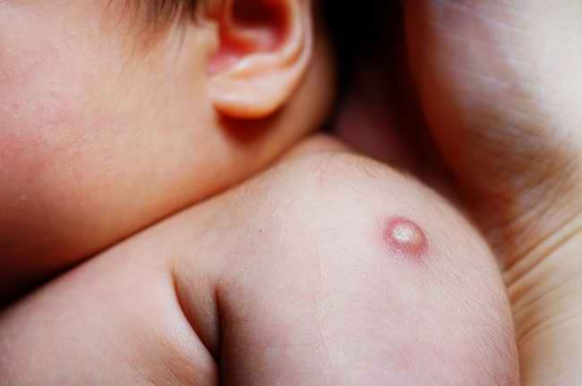 Muncul Bisul setelah Imunisasi BCG, Apakah Berbahaya? - Alodokter