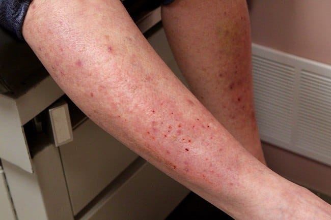 Dermatitis Herpetiformis - Alodokter