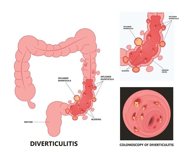 Divertikulitis - Alodokter