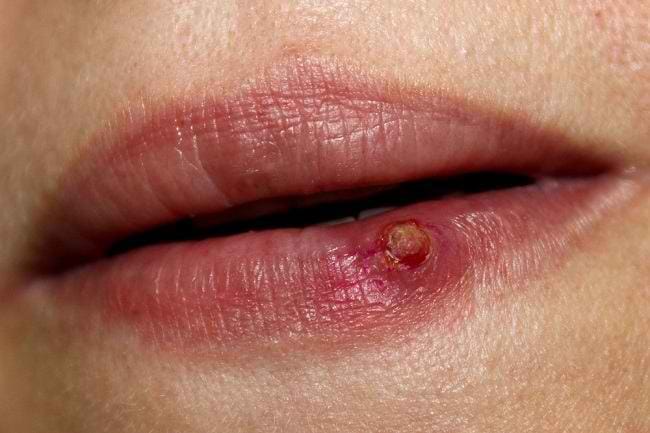 Memahami Granuloma dan Jenisnya - Alodokter