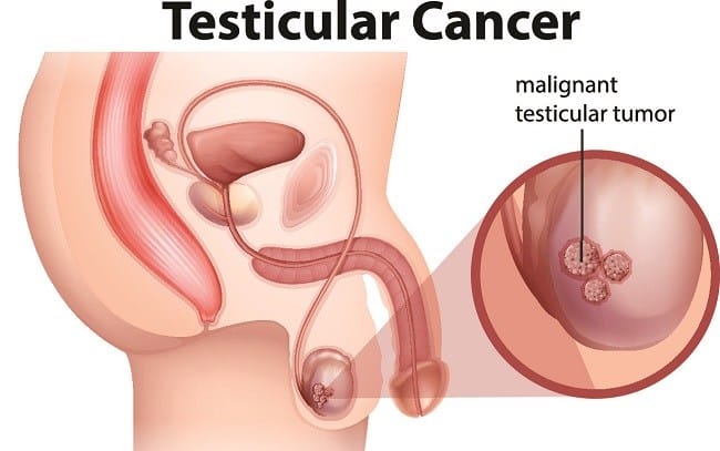 Kanker Testis - Alodokter