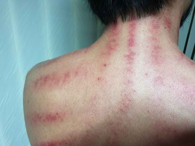 Makin Merah Kerokan, Makin Parah Masuk Angin? Ini Faktanya - Alodokter