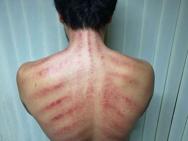 Kerokan Kebanyakan Dilakukan di Punggung, Ini Alasannya - Alodokter