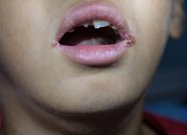 Cheilitis Angular - Alodokter