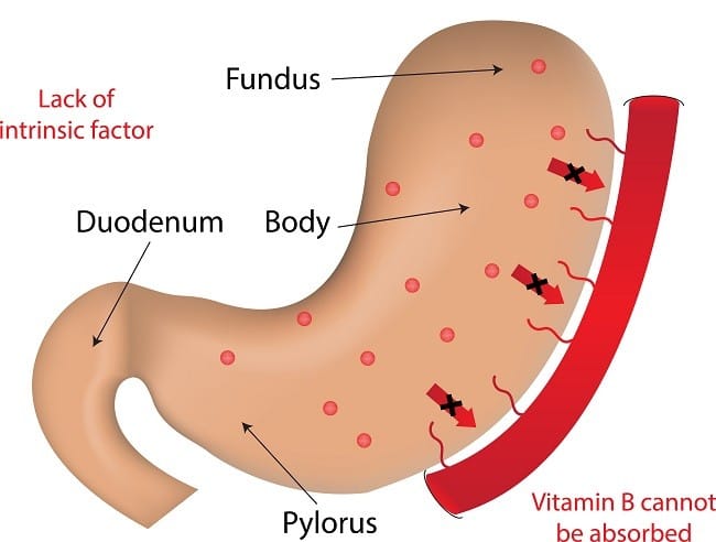 Anemia Pernisiosa - Alodokter