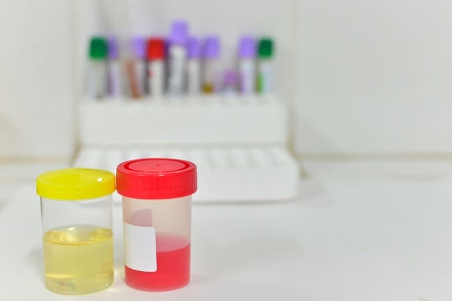 Mengetahui Penyebab dan Obat Kencing Darah yang Tepat - Alodokter