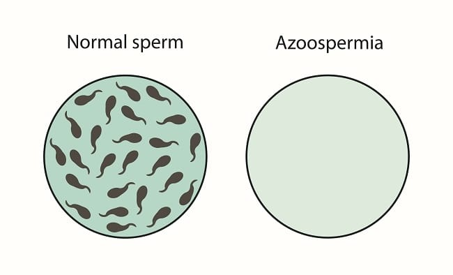 Azoospermia - Alodokter