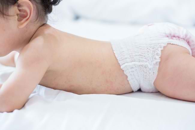 Beragam Masalah pada Kulit Bayi dan Cara Merawatnya - Alodokter