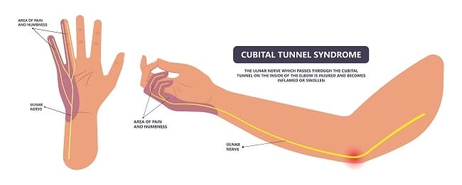 Cubital Tunnel Syndrome - Alodokter