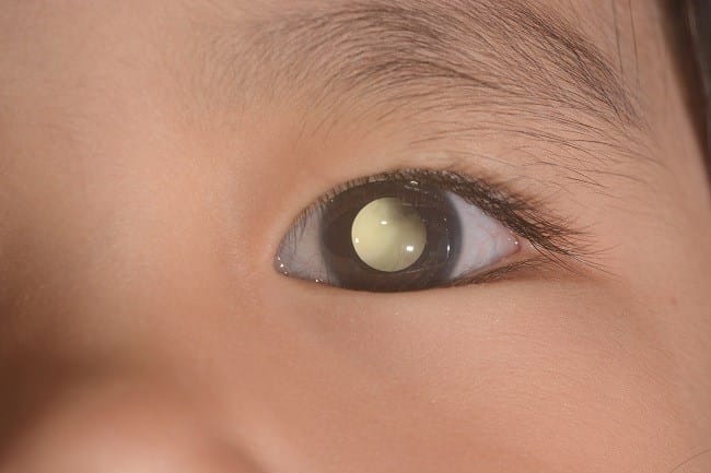 Retinoblastoma - Alodokter