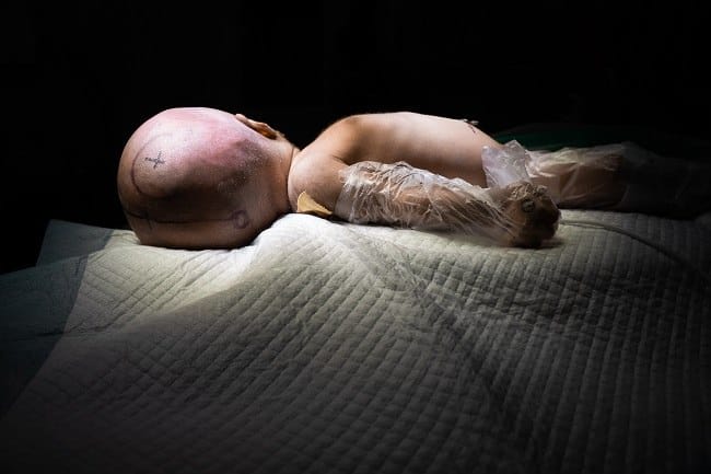 Dandy-Walker Syndrome - Alodokter