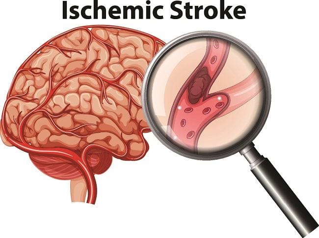 Stroke Iskemik - Alodokter