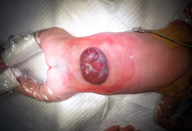 Spina Bifida - Alodokter