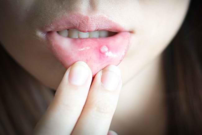 Ketahui 5 Jenis Obat Sariawan Ampuh di Sini - Alodokter